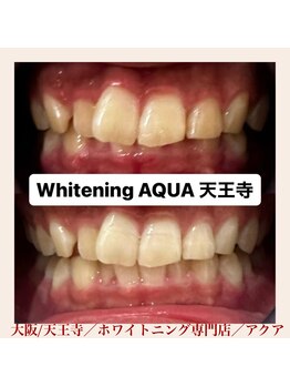 アクア 天王寺店(AQUA)/セルフホワイトニング/天王寺