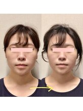 アレイズ/小顔矯正コース