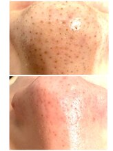 ムーニ(MOONI)/《毛穴洗浄/ビフォーアフター》