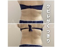 エアリアル 大川店/くびれができる脂肪冷却痩身