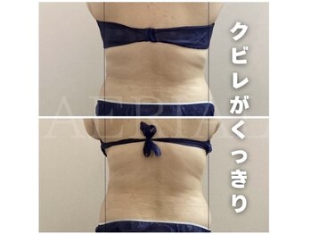エアリアル 大川店/くびれができる脂肪冷却痩身