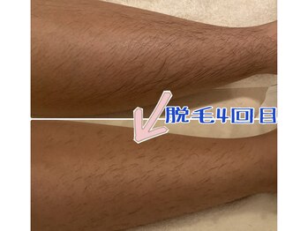 トータルビューティーサロン 凛/肌も綺麗になる脱毛