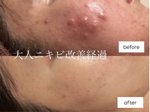 アルフォービューティー 広島店(ALU for beauty)の雰囲気（繰り返すニキビにもオーダーメイドで対応◎跡にさせない改善を）