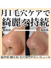 ピュール 鯖江店(PUR)/毛穴/毛穴ケア/毛穴洗浄