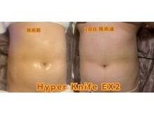 ドクタースタイル(Dr.style)/ハイパーナイフEX22回目施術後