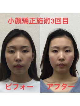 オズ六本木/六本木小顔矯正(整顔)施術3回