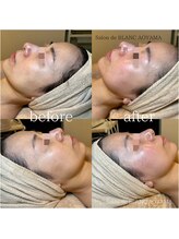 サロン ド ブラン アオヤマ(Salon de BLANC AOYAMA)/ビオフィート×ソノケア