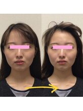 アレイズ/小顔矯正コース