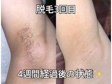 リエル(RIEL)/【ワキ脱毛】