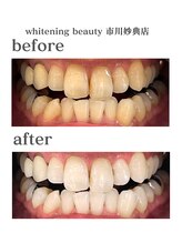 ホワイトニングビューティー 市川妙典店/歯科提携/ホワイトニング/妙典