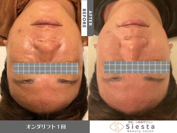 シエスタ(siesta)/韓国脂肪分解リフト(全顔小顔)