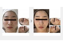 スイ 昭島店(Sui)/ホワイトスノーピール/シミ/美白