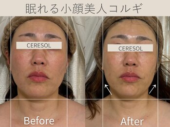 セレソル(CERESOL)/〈40代女性〉施術1回での効果＊