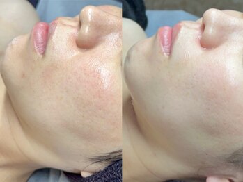 エモーショナル 姫路(Emotional)/韓国ピーリングでくすみ改善