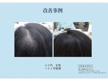 ラ ソワ(la soie)/育毛促進ヘッドスパ　40代女性