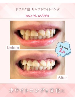 エクシアホワイトニング 江坂店/ビフォーアフター
