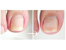 巻き爪フットケアサロン 神楽坂/プレート巻き爪ケア