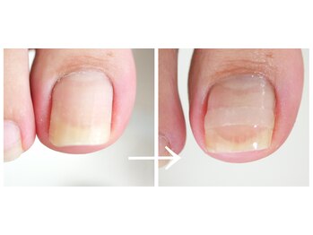 巻き爪フットケアサロン 神楽坂/プレート巻き爪ケア