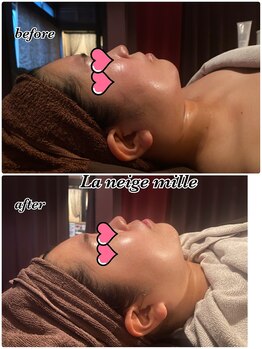 ラネージュミル(La neige mille)/小顔フェイシャル