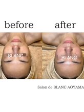 サロン ド ブラン アオヤマ(Salon de BLANC AOYAMA)/ビオフィート×ソノケア