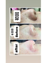 リンカ(Rinca)/毛穴エクストラクション/尾張旭