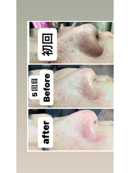 リンカ(Rinca)/毛穴エクストラクション/尾張旭