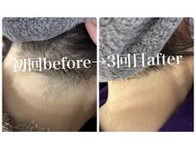 カフー(KAFUU)/うなじ/襟足脱毛　before after