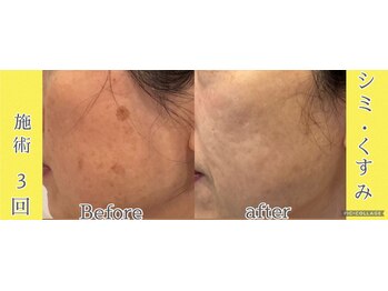 レゴリス/IPL光フェイシャル