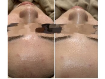 リグレム バイ フェローズ(Riglem by fellows)/トーンアップ★全顔脱毛