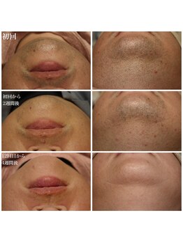 ベビースキン(baby skin)/髭脱毛