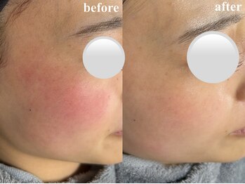 ユネ(une)の写真/【韓国式肌管理】MTSノーファンデアンプルで究極の肌管理★透明感溢れる水光＆ツヤ肌でトーンアップが叶う!