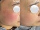 ユネ(une)の写真/【韓国式肌管理】MTSノーファンデアンプルで究極の肌管理★透明感溢れる水光＆ツヤ肌でトーンアップが叶う!
