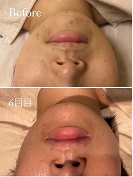 ルーヴェ(Luve)/陶肌トリートメント