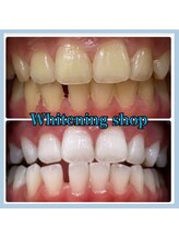 ホワイトニングショップ 堺東店/【ビフォーアフター】10回