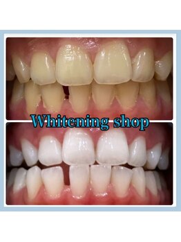 ホワイトニングショップ 堺東店/【ビフォーアフター】10回