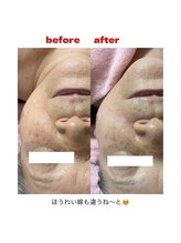 ブーケ(bouquet)/ほうれい線にも効果