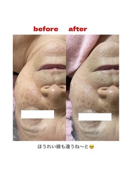 ブーケ(bouquet)/ほうれい線にも効果