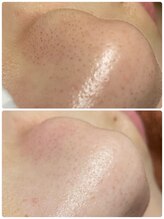 美肌脱毛専門店 パールプラス 大在店/顔脱毛