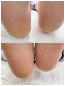 リンネ(Rinne)/角質ケア