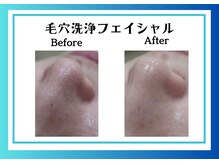 リヴェーヌ 富山店/毛穴の汚れも改善