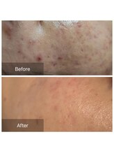 ピンクッション 平尾(PINKSHION)&nbsp;ニキビ 肌荒れにも