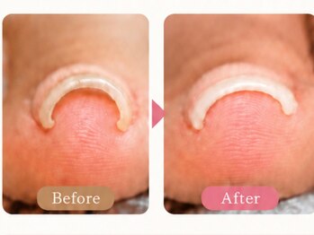 デヴォーションネイル 青梅新町店(Devotion NaiL)の写真/巻き爪が気になる方へ♪爪の状態に合わせた巻き爪ケアで、見た目も自然に♪健康的な爪を目指します☆