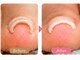 デヴォーションネイル 青梅新町店(Devotion NaiL)の写真/巻き爪が気になる方へ♪爪の状態に合わせた巻き爪ケアで、見た目も自然に♪健康的な爪を目指します☆