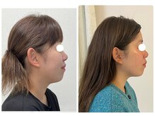 ワイサロン(Y salon)/【小顔症例】コルギ　13回目