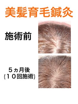 鍼灸サロンオランジュ 高槻富田院/美髪育毛鍼灸