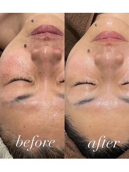 ウィズルーチェ つくばみどりの店(with luce)/日焼けによる肌トラブル緩和