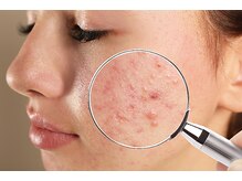 ブリエ 自由が丘(briller)/【徹底的にニキビケア】