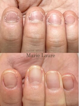 マリーロール 淀屋橋本店(Marie Laure)/自爪育成/深爪矯正/ネイルケア