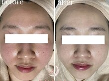 トータルビューティサロン ルボン(RUBON)/ドクターリセラアクア症例