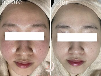 トータルビューティサロン ルボン(RUBON)/ドクターリセラアクア症例